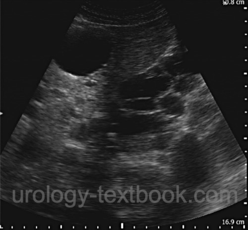 figure renal ultrasound imaging in ADPKD