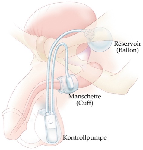 figure artificial urinary sphincter AMS 800 for the treatment of urinary incontinence