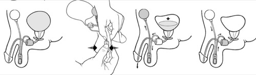 figure control of the artificial urinary sphincter AMS 800