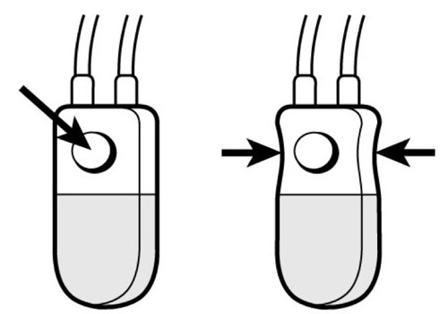 figure deactivation of the artificial urinary sphincter AMS 800