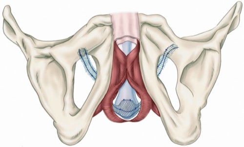 fig. Advance male sling system for the treatment of stress urinary incontinence after radial prostatectomy