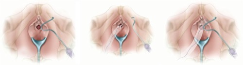fig. Transobturator mid-urethral sling or transobturator tape (TOT).
