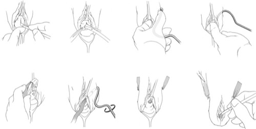 figure Retropubic sling implantation (Sparc system from AMS)