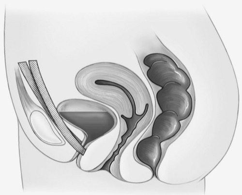 figure alloplastic vaginal mid-urethral sling