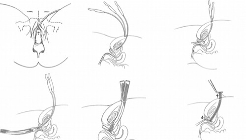 figure Retropubic sling implantation (Sparc system from AMS)