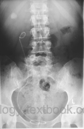 Plain X ray of a young girl with two stones in situ. (a). Stone in