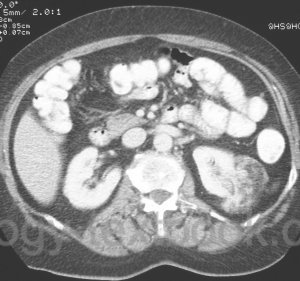 fig. CT abdomen of renal angiomyolipoma