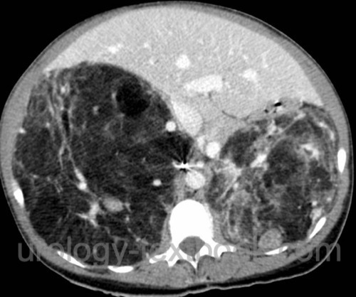 figure Bilateral angiomyolipomas in a patient with tuberous sclerosis