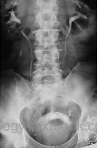 urography in benign prostatic hyperplasia BPH