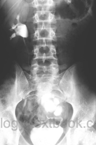 urography of a pelvic kidney (renal ectopia)