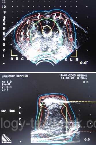 figure Dosimetry during brachytherapy