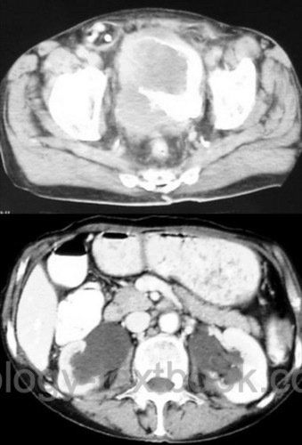 figure Computed tomography CT abdomen of advanced bladder cancer