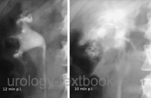 figure Intravenous urography: left ureteral stone with grade II hydronephrosis.