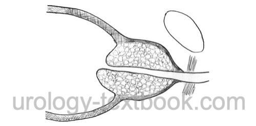 figure: surgical principle of suprapubic transvesical prostatectomy for BPH