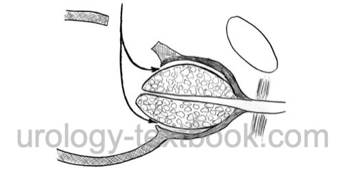 figure: surgical principle of suprapubic transvesical prostatectomy for BPH