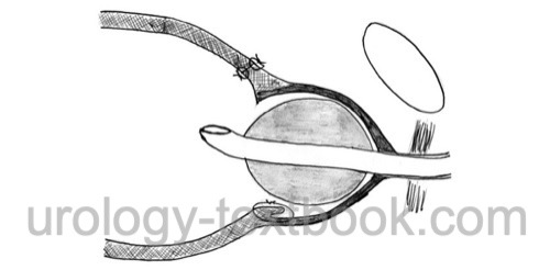 figure: surgical principle of suprapubic transvesical prostatectomy for BPH