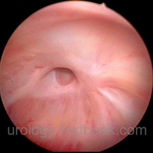 figure: Anastomotic stricture after radical prostatectomy