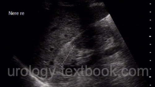 figure ultrasound imaging of renal angiomyolipoma