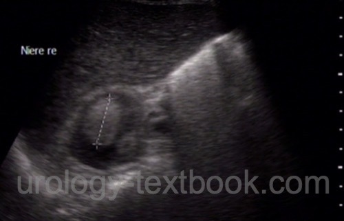 figure ultrasound imaging of renal angiomyolipoma