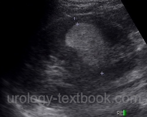 figure ultrasound imaging of renal angiomyolipoma