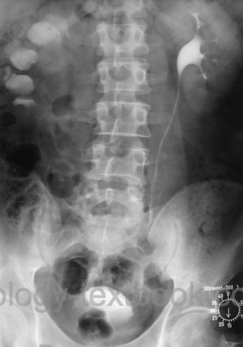 figure Intravenous urography of a right-sided proximal ureteral stricture with third-grade hydronephrosis