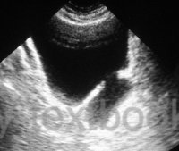 fig. ultrasound imaging in BPH: bladder diverticula
