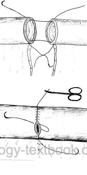 figure hand-sewn bowel anastomosis