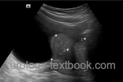 Intravesical prostatic protrusion Intravesical prostatic protrusion on transabdominal ultrasonography