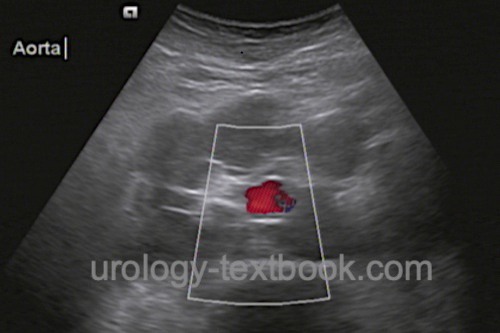 Transverse abdominal ultrasound showing para-aortic lymphadenopathy