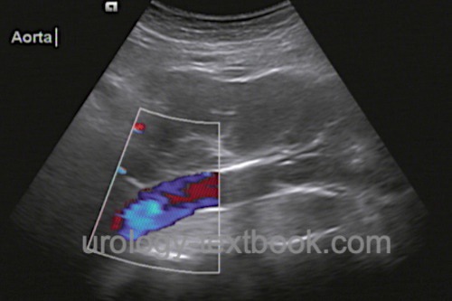 Sagittal abdominal ultrasound showing para-aortic lymphadenopathy