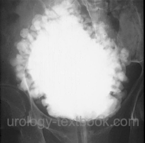 figure VCUG in NLUTD: multiple small pseudodiverticula and trabeculae (christmas tree bladder or pine cone bladder) indicate voiding under high pressure with detrusor-sphincter dyssynergia