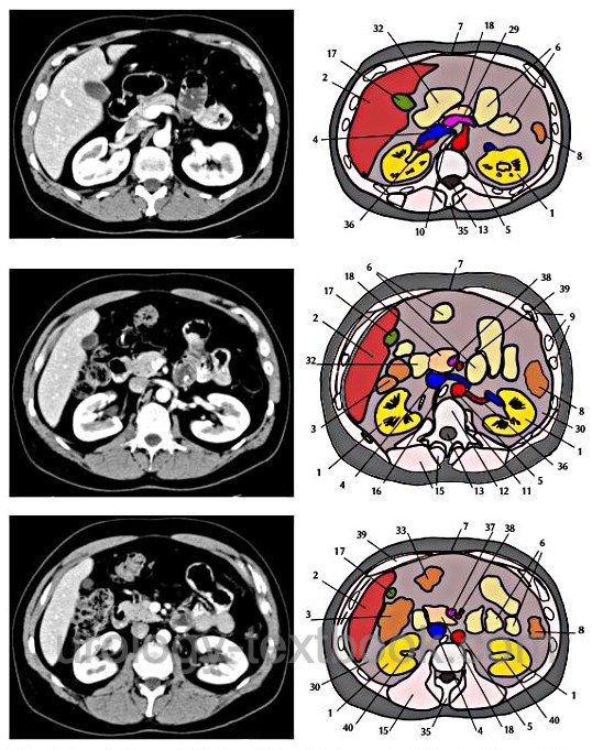 figure Normal Findings and Sectional Anatomy of abdominal CT Scans