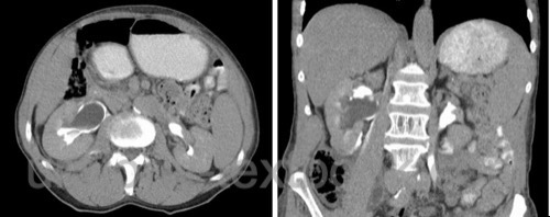 figure Abdominal CT with right-sided forniceal rupture