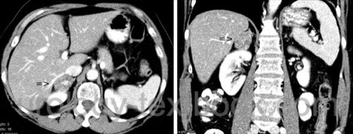 figure CT of the abdomen showing an adrenal incidentaloma