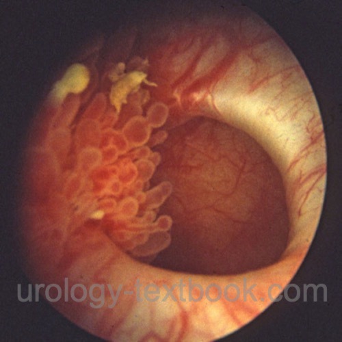 figure cystoscopic findings of bladder diverticulum with bladder carcinoma