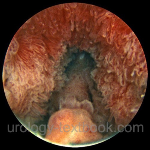 fig. Cystoscopy: urothelial carcinoma of the prostatic urethra.