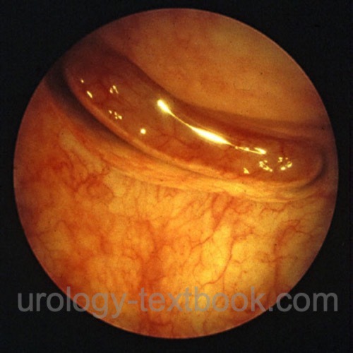 figure cystoscopy Air bubble at the bladder roof