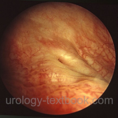 figure cystoscopy Normal right-sided ureteral orifice