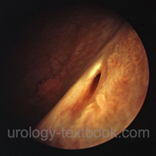 figure cystoscopy Normal left-sided ureteral orifice