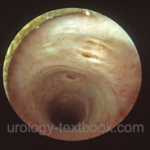 figure cystoscopy Male penile urethra with openings of the glandulae urethrales (Littré glands)