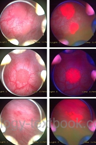 figure Fluorescence cystoscopy of bladder carcinoma