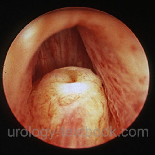 figure cystoscopy Prostatic urethra with verumontanum (seminal colliculus)