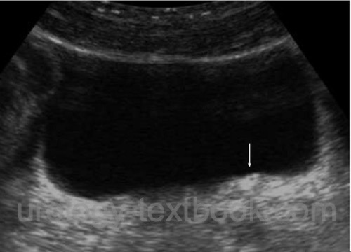 figure Ultrasound imaging of the bladder with a prevesical left ureteral stone (arrow).