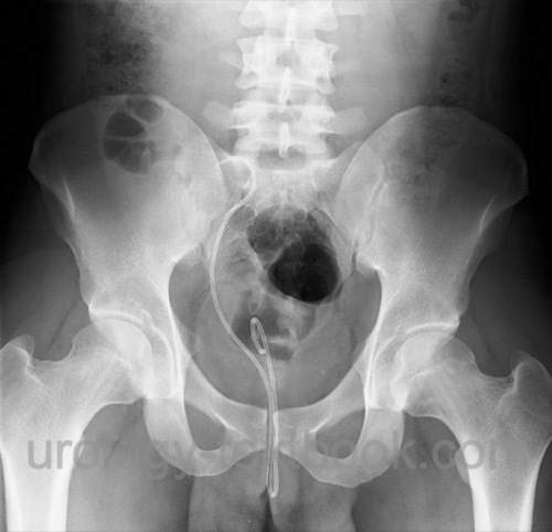 figure dislocated DJ stent with urinary incontinence