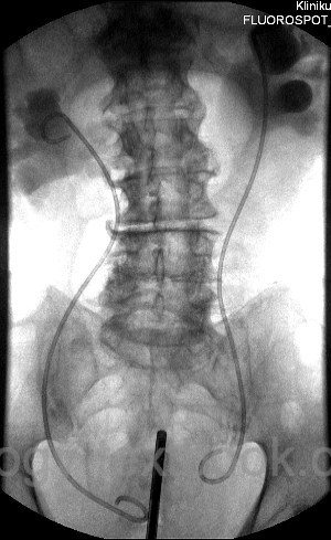 Bilateral DJ ureteral stents