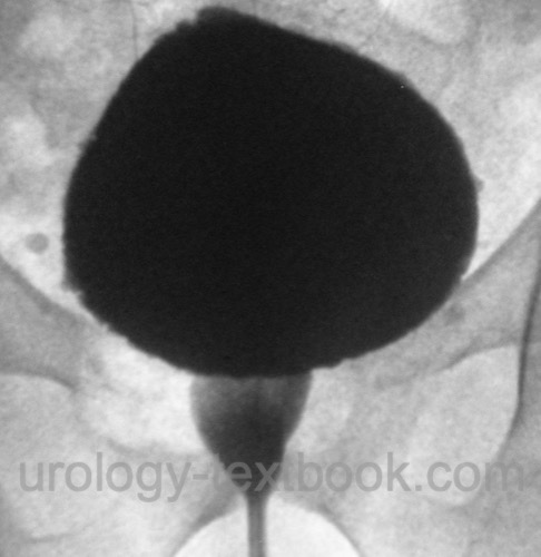 figure Signs of detrusor-sphincter dyssynergia on VCUG