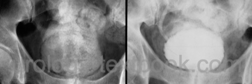 figure Emphysematous cystitis in i.v. urography