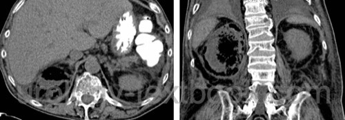 figure CT scan of Emphysematous pyelonephritis