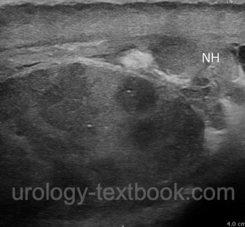 ultrasound imaging of an epididymitis