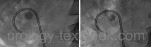 fig. imaging of stone disintegration after extracorporeal shock wave lithotripsy (ESWL)